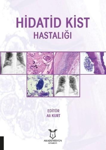 Hidatid Kist Hastalığı | Kitap Ambarı